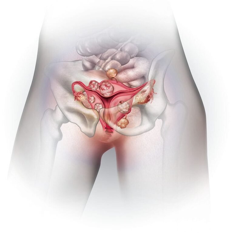 Uterine Fibroids