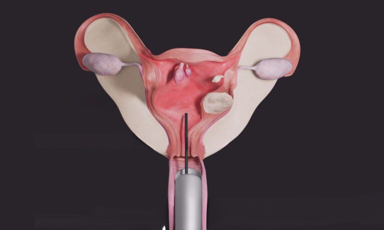 Hysteroscopy