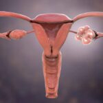 Best PCOS Treatment in Kolkata and Howrah